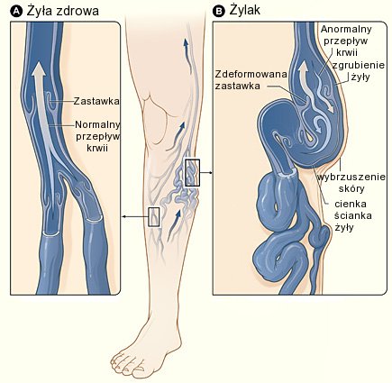 Czym są żylaki i jak się je leczy?